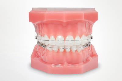 ortodoncia en andoain. brackets